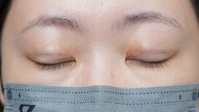 手術前の状態 その1