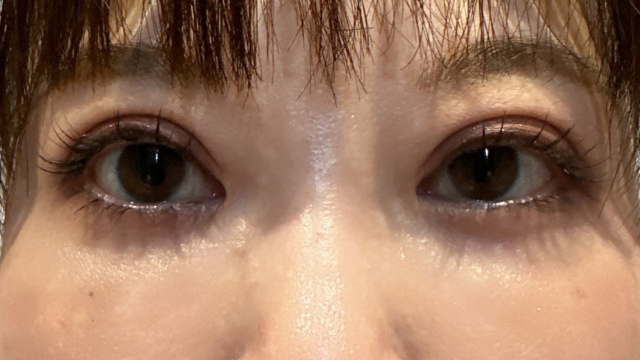 手术前的状态 其一