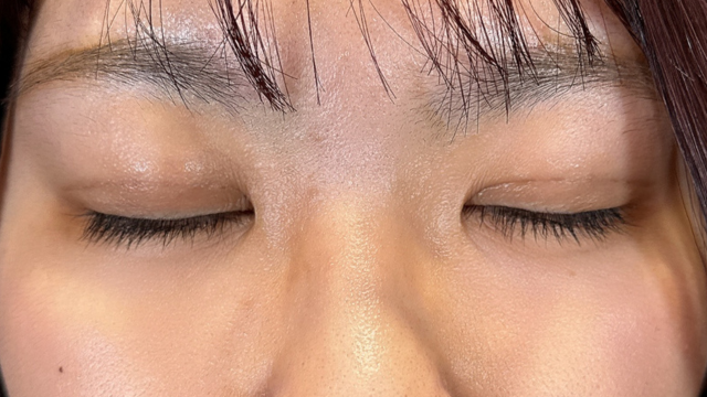 手术前的状态 其一