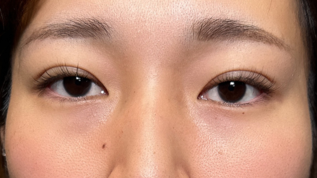 手術前の状態 その1