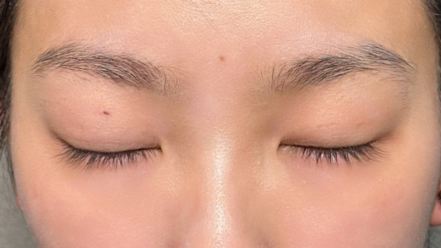 手术前的状态 其一