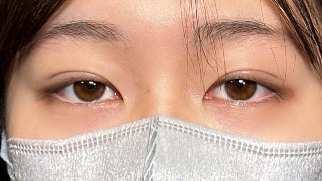 手术前的状态 其一