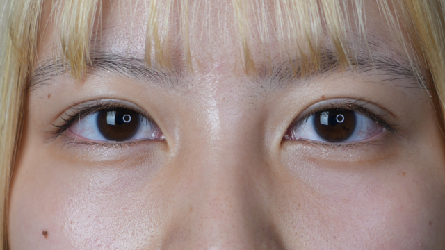 手術前の状態 その1