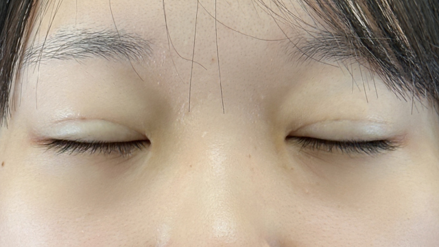 手术前的状态 其一