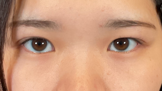 手術前の状態 その1