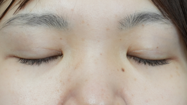 手術前の状態 その1