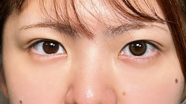 手术前的状态 其一