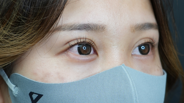 手術前の状態 その1