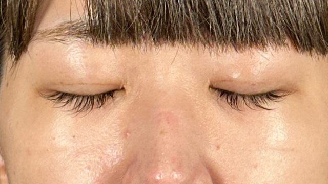 手术前的状态 其一