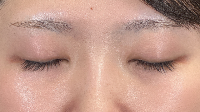 手术前的状态 其一