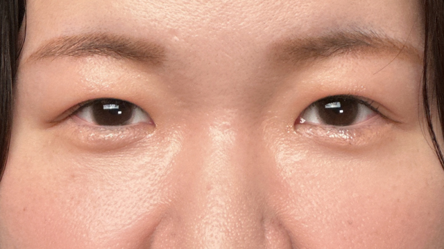 手术前的状态 其一