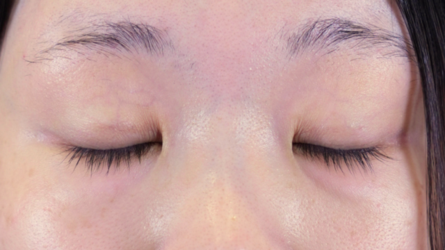 手术前的状态 其一