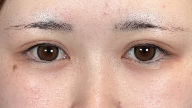 手術前の状態 その1