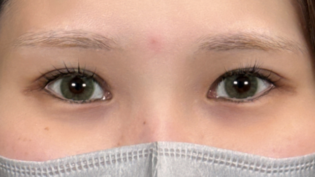 手术前的状态 其一