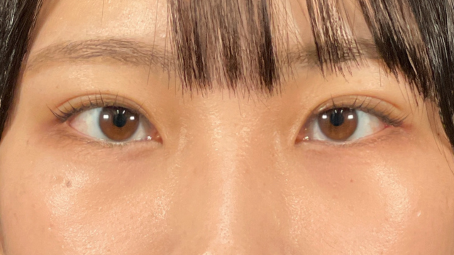 手術前の状態 その1