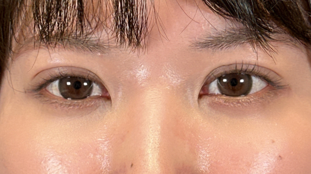 手術前の状態 その1