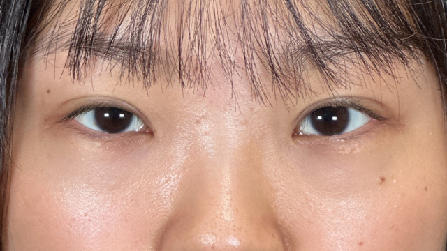 手術前の状態 その1