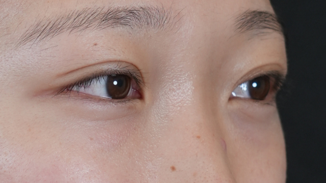 手術前の状態 その1