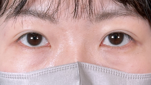 手術前の状態 その1