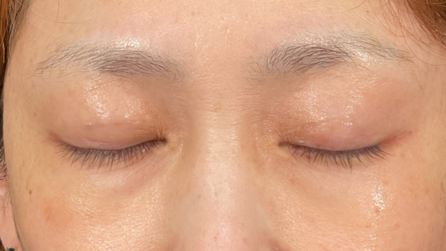 手術前の状態 その1