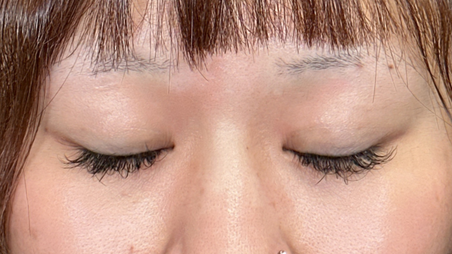 手术前的状态 其一