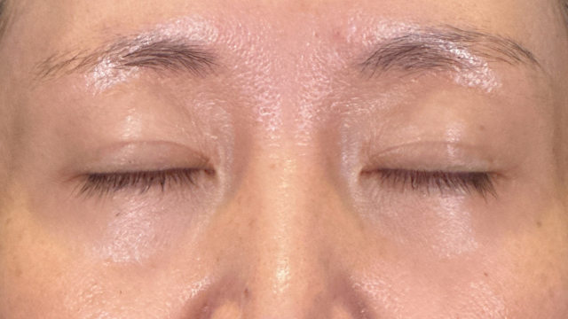 手術前の状態 その1