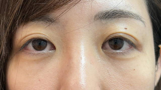 手术前的状态 其一