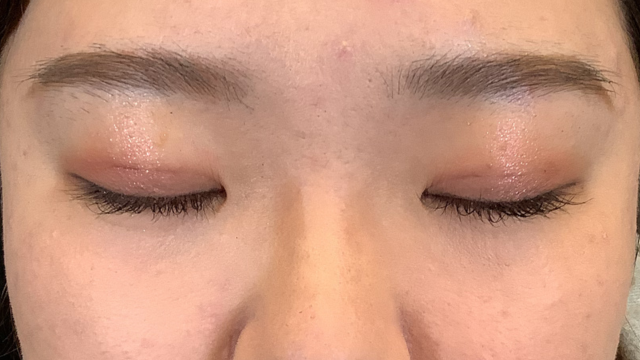 手術前の状態 その1