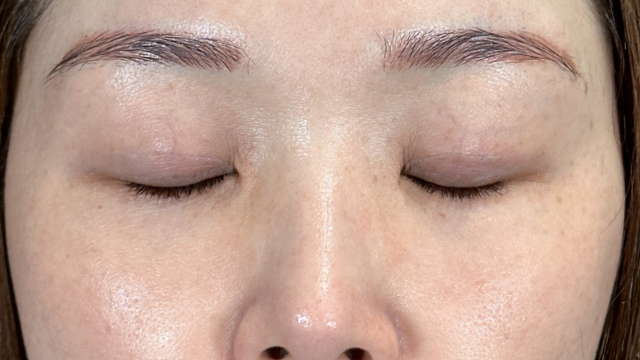 手術前の状態 その1