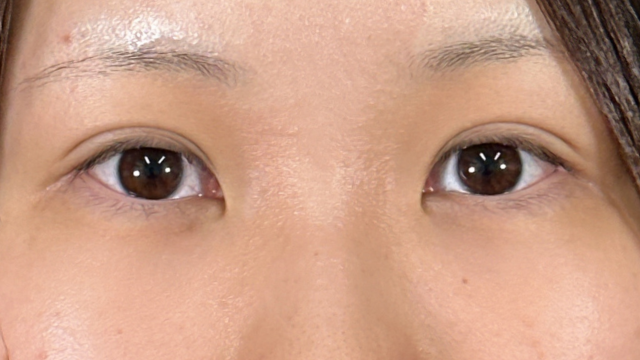 手术前的状态 其一