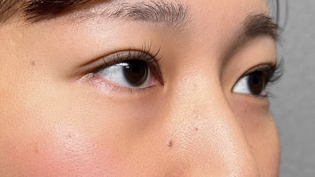 手術前の状態 その1