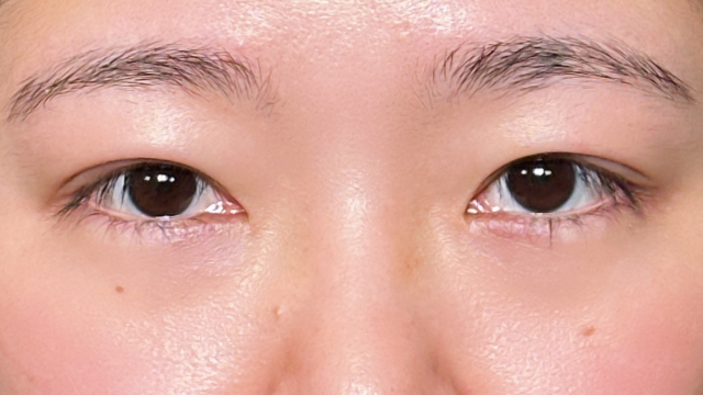 手术前的状态 其一