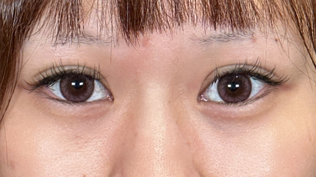 手术前的状态 其一