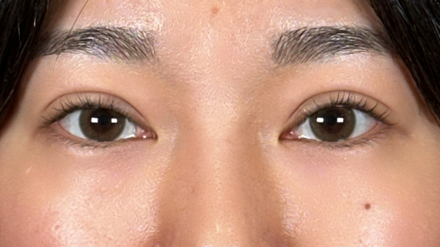 手術前の状態 その1