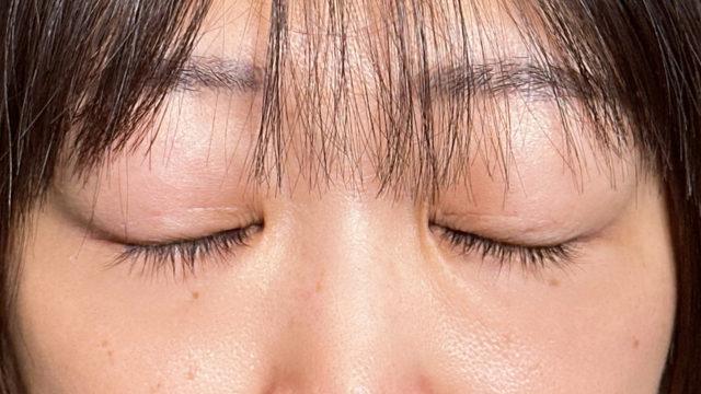 手術前の状態 その1