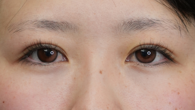 手术前的状态 其一