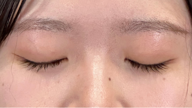 手术前的状态 其一