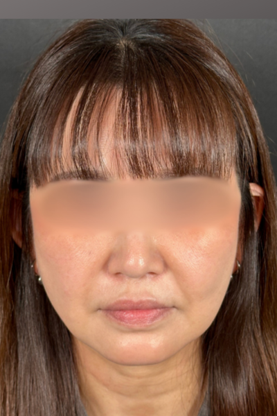 手術前の状態 その1