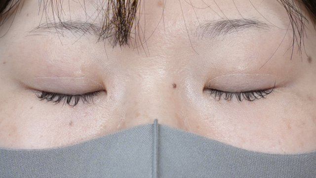 手术前的状态 其一