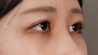 手術前の状態 その1