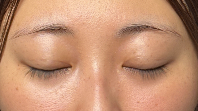 手術前の状態 その1