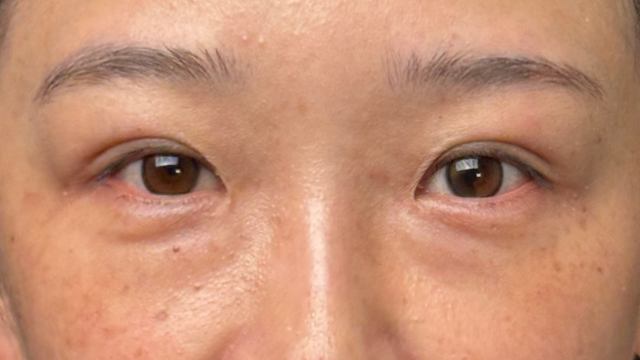 手术前的状态 其一