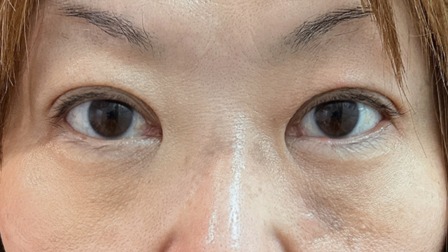 手术前的状态 其一