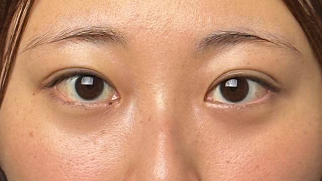 手術前の状態 その1