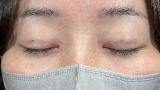 手术前的状态 其一