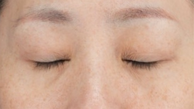 手术前的状态 其一