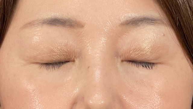 手术前的状态 其一