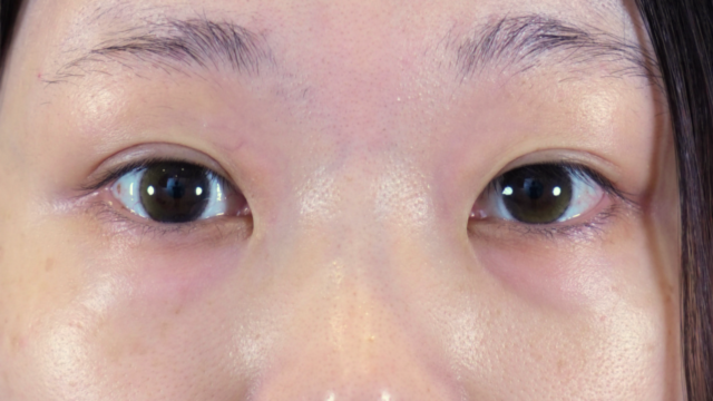 手术前的状态 其一