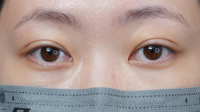 手術前の状態 その1