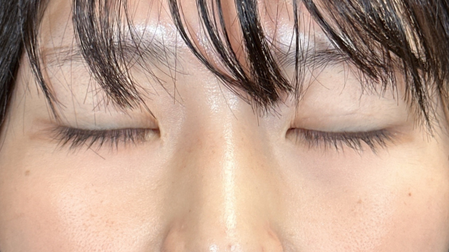 手術前の状態 その1